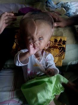 Zahara Lestari Butuh Uluran Tangan Dermawan