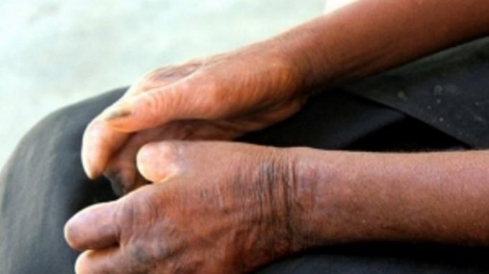 Indonesia Ranking 3 Penderita Kusta di Dunia