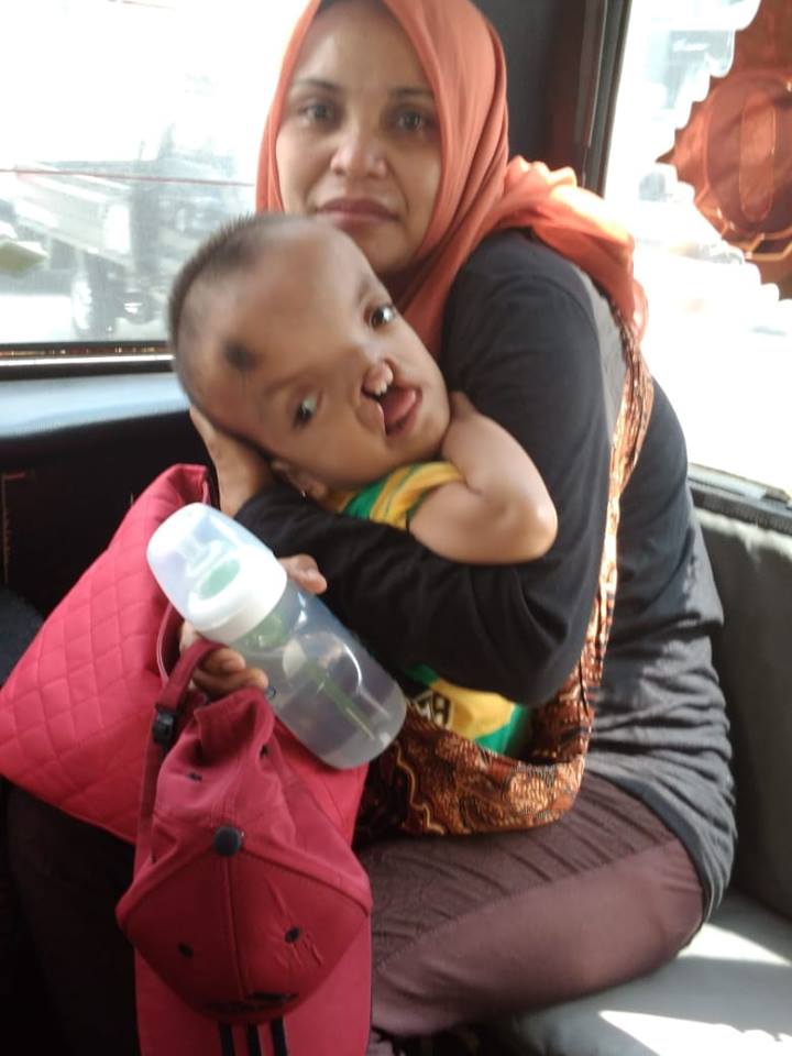 Alami Pembengkakan Saraf,  Dede Q Butuh Uluran Tangan Dermawan