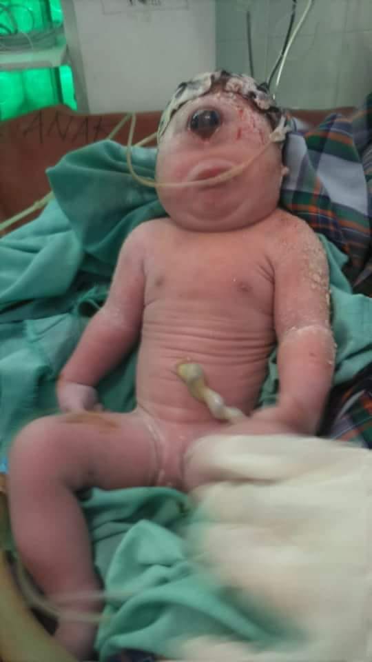 Bayi Perempuan Tanpa Hidung dan Bermata Satu Lahir di RSU Panyabungan