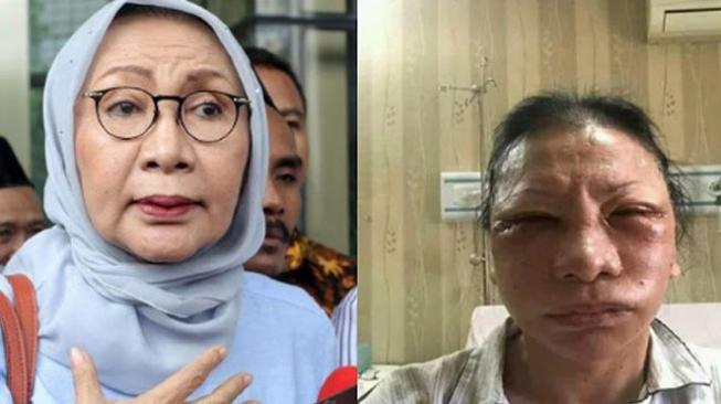 Inilah Kebohongan Ratna Sarumpaet Sebenarnya?