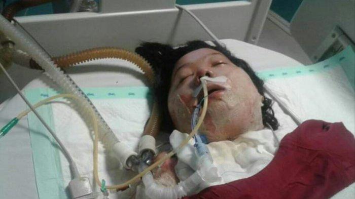 Kritis 48 Hari, Hovonly Mahasiswi Dibakar Mantan Pacar Meninggal