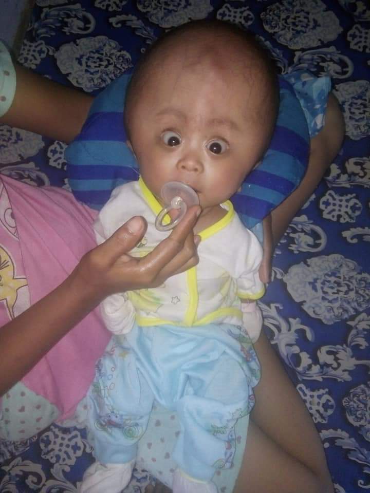 Afdun, Bayi Penderita Hidrosefalus Asal Sibolga Butuh Donasi Dermawan
