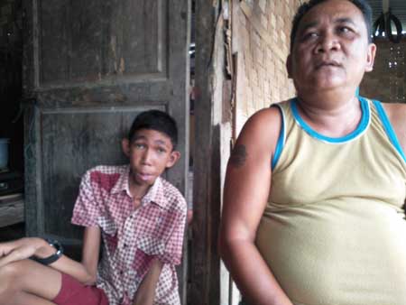 Tanpa Rahang, Rudi Asono Warga Bilah Hilir Harapkan Bantuan Dermawan