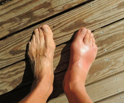 Perlu Diketahui, Ini Pilihan Alami Obat Asam Urat Paling Ampuh