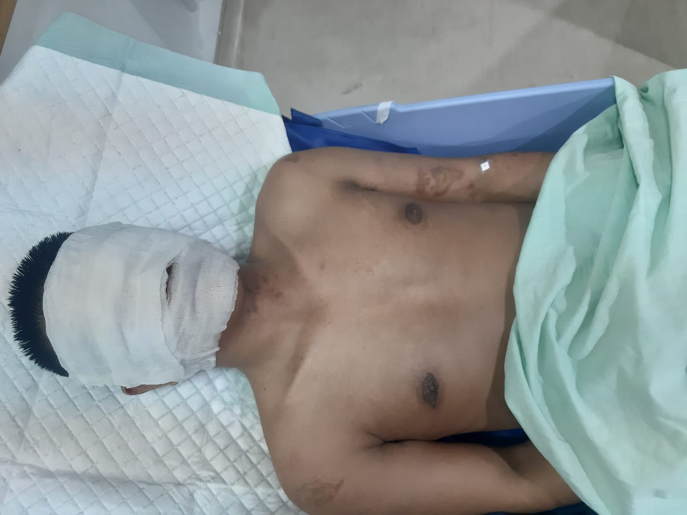 Wartawan di Medan Diserang OTK, Wajah Disiram Air Keras