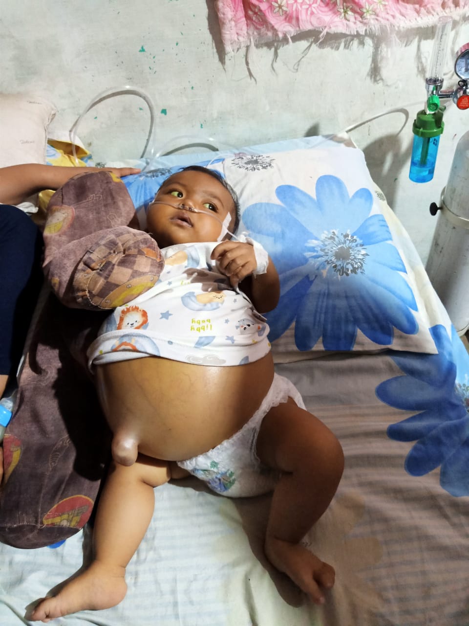Bobby Nasution Gerak Cepat Boyong Bayi Aiyla Penderita Astresia Bilier ke RS Adam Malik