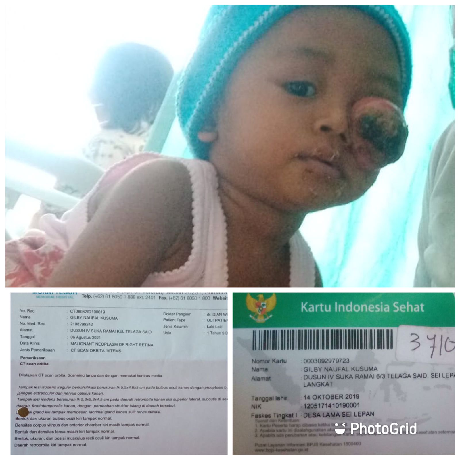 GJS dan Sedulur Selawase Ajak Donasi untuk Penderita Tumor Mata di Langkat