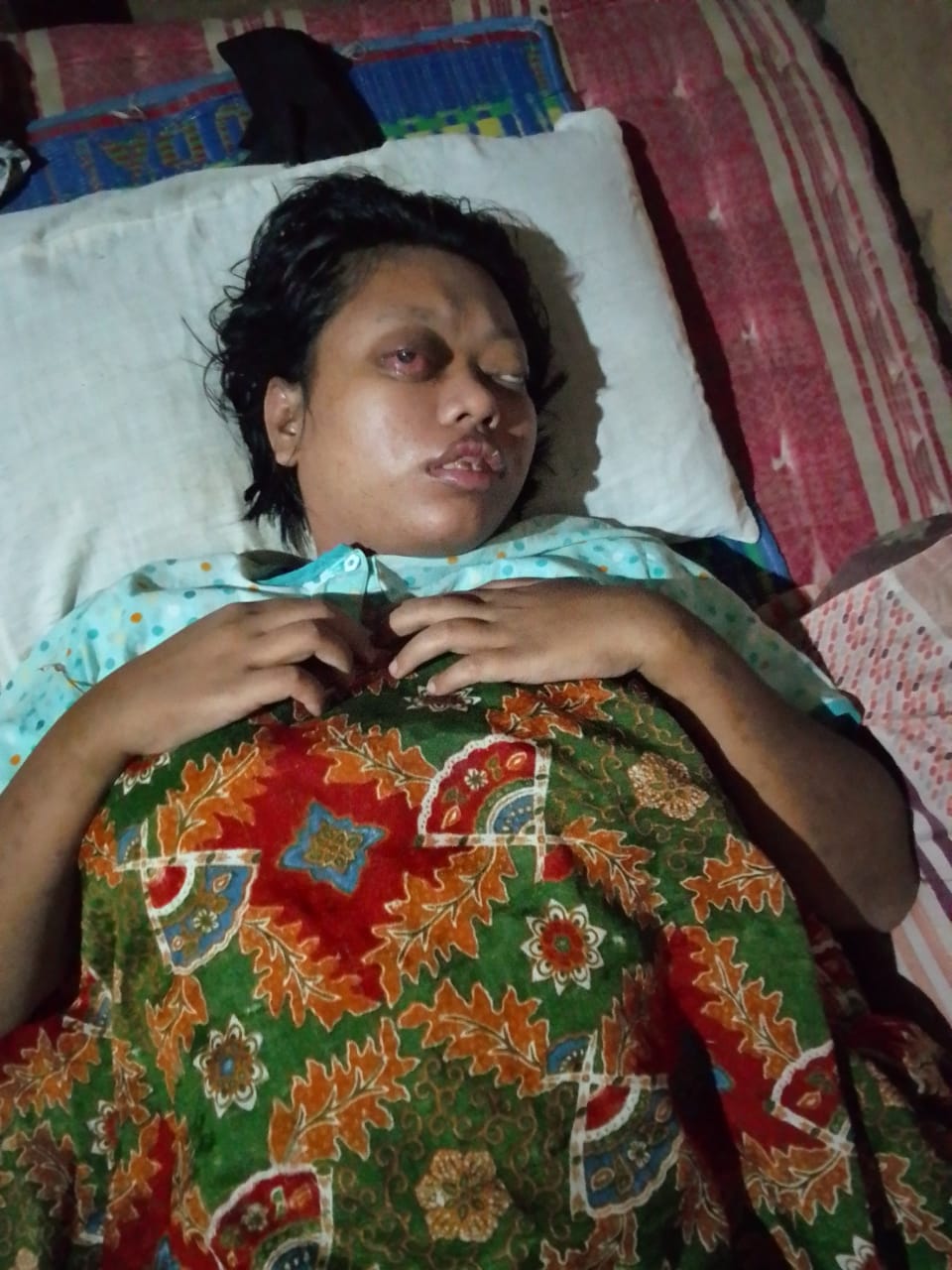 Sumiati gadis malang warga Natal Madina Butuh Bantuan Dermawan