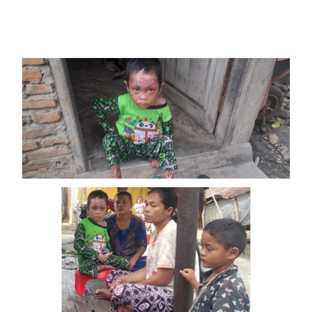 Sedih.!! Rayhan Lubis Derita Penyakit Langka 