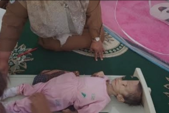 Kembali di Temukan Gizi Buruk dikota Padangsidimpuan, Ini Keterangan Kadinkes