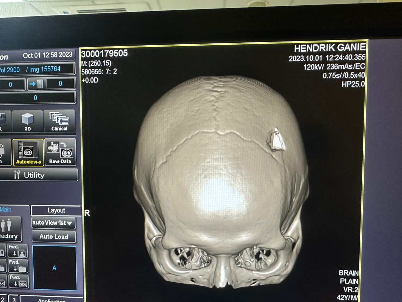 Pengunjung Hotel Grand Centra Hendrik Ganie Korban Pengeroyokan,Â  Â Kuasa Hukum Rinaldi SH : Ngadu ke Poltabes Minta Kasusnya Diproses Hukum