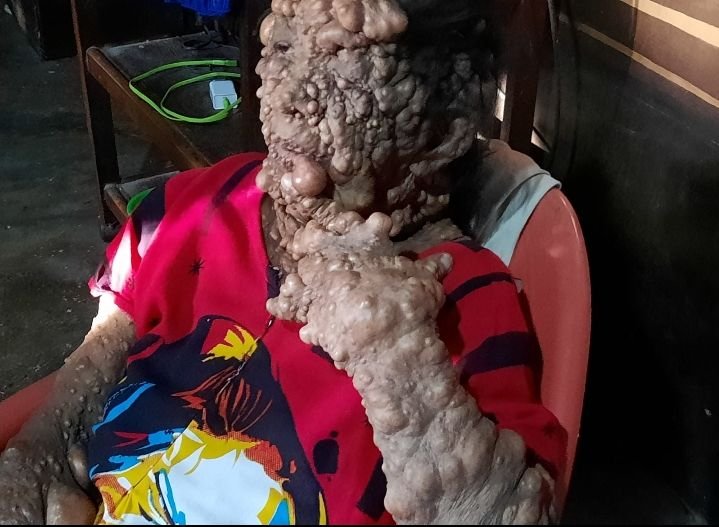 Nelliati Bertahan Hidup dengan Penyakit Langka yang Memprihatinkan di Simbolon