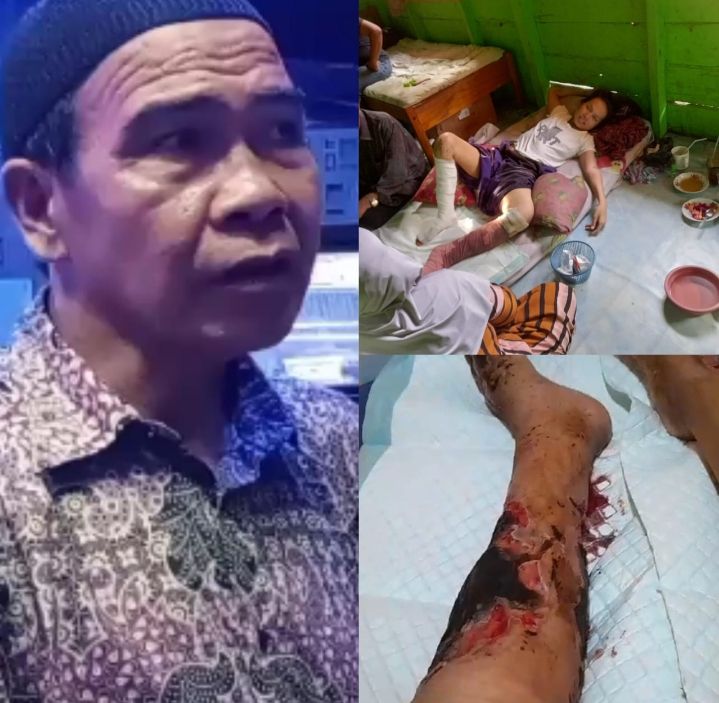 Miris, .Masyarakat Padangsidimpuan Sri Wahyuni Diterpa Penyakit Serius Luput dari Perhatian Pemerintah Padangsidimpuan