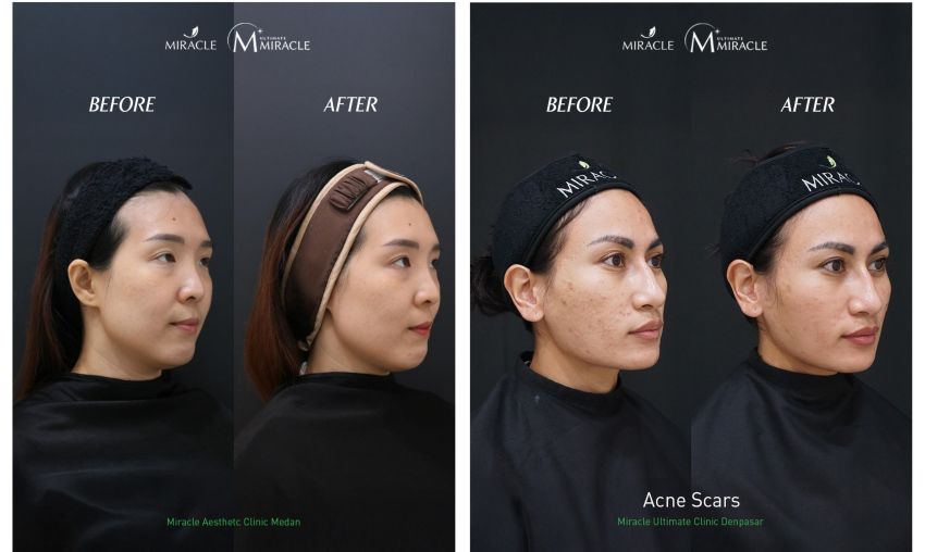 Miracle Aesthetic Clinic, Tangani Hiperpigmentasi Kulit Pelanggan Indonesia